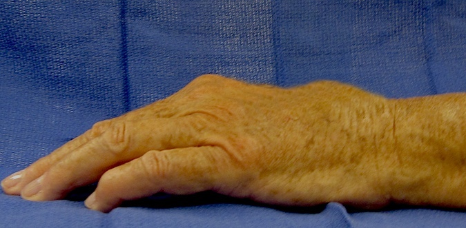 Extensor Tendon Ruptures ( Vaughan-Jackson Syndrome) (Hover over right edge to see more images)