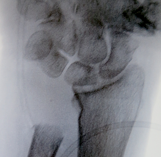 DRUJ post Distal Ulna Resection