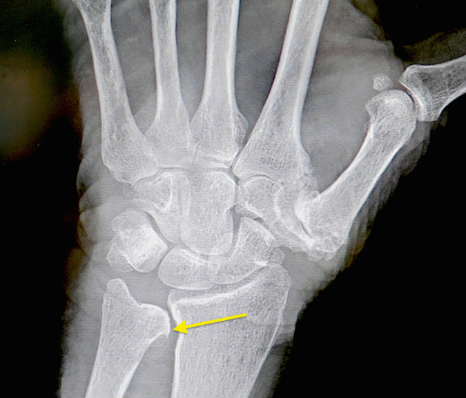 DRUJ OA (arrow) & Thumb CMC OA (Hover over right edge to see more images)