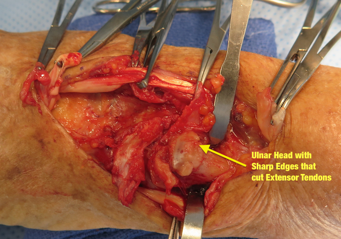 Arthritic Ulnar Head exposed with osteophytes that acted as sharp teeth which ruputred the extensor tendons