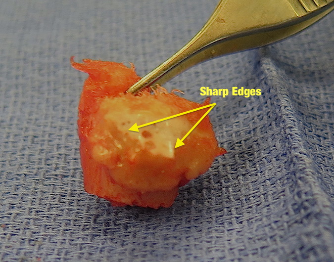 Resected arthritic ulnar head