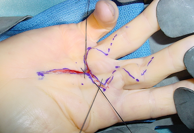 Zig-Zag incisions with distal web flap with retention sutures in place.