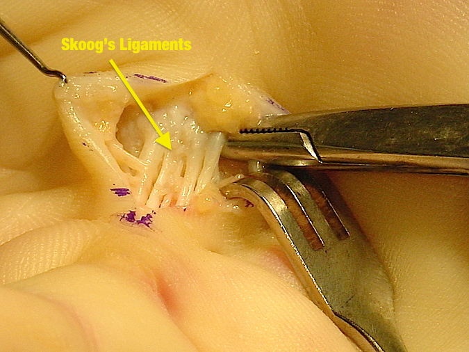 Close up view of Skoog's ligaments(superficial inter metacarpal ligaments)