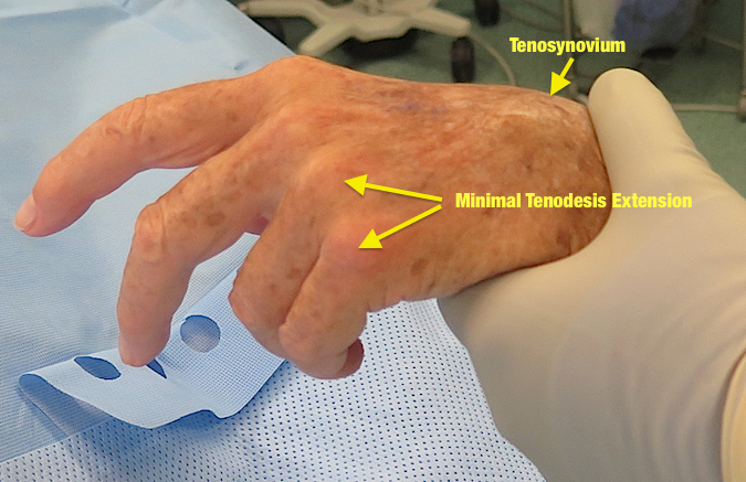 No Tendodesis Affect demonstrated in 4th & 5th fingers with wrist palmar flexion