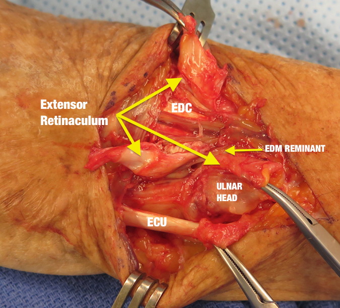 Retinacular Flaps Made & Intact Extensors Exposed (Hover over right edge to see more images)