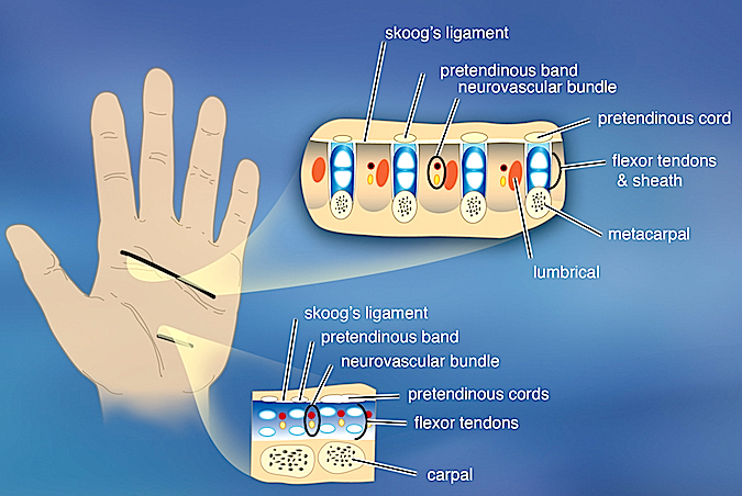 Cross sectional anatomy at Mp joint level and at the proximal extent of the dissection of Dupuytren's cords. Note relationship of the pathologic cords to the tendons and neuromuscular structures.