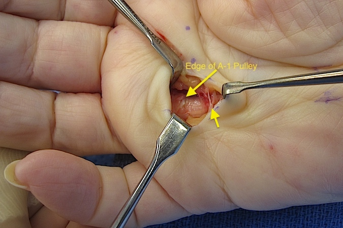 Edge os A-1 exposed. Second arrow at fiber of palmar aponeurotic pulley(superficial inter metacarpal ligaments).