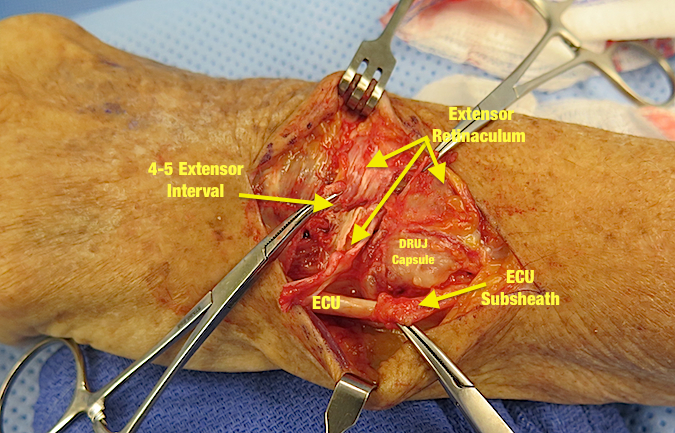 Retinacular Flaps and DRUJ Capsule