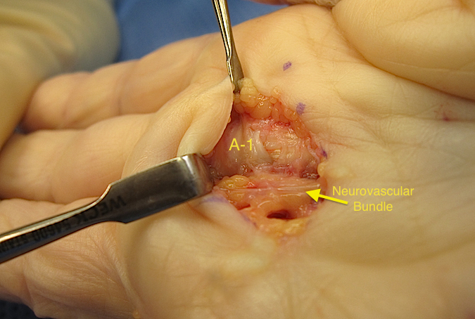 A-1 pulley exposed and neurovascular bundle visible.