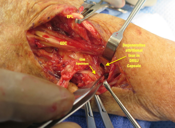 Attritional defect in DRUJ Capsule which allowed arthritic ulnar head to ruputre the extensor tendons( EDM, EDC V , EDC IV and partially rupture EDC III