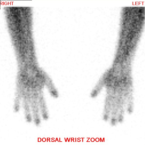 Hand and Wrist Bone Scan - Dorsal View