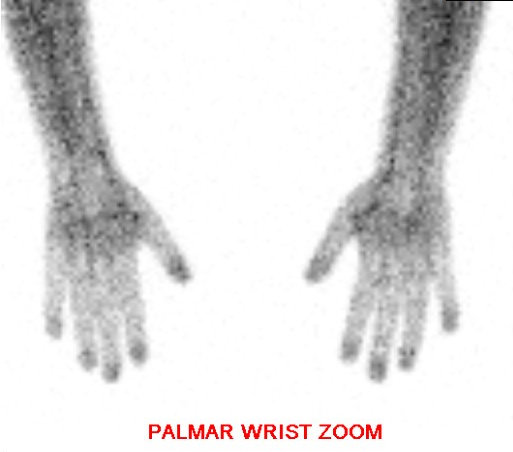 Hand and Wrist Bone Scan - Palmar View