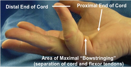 Central Cord - Injection site located in part of the cord which is most "bowstrung" (displaced away from the flexor tendons.