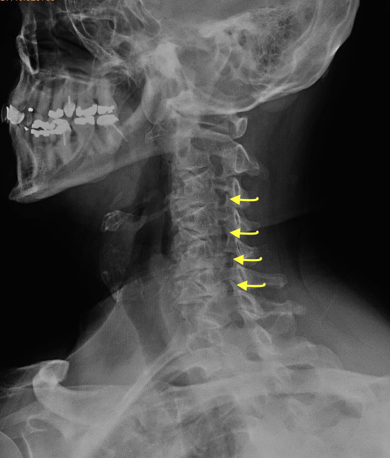  Cervical Osteoarthritis and disk space narrowing on oblique view.  Note foramen impingement at arrows.  In this AP view the head is rotated 45 degrees to RIGHT so the LEFT cervical foramen are demonstrated.