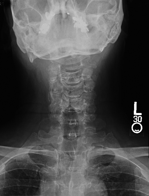  Cervical Osteoarthritis and disk space narrowing AP view