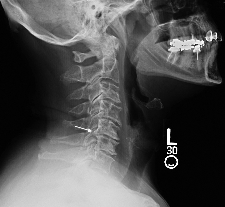 Significant Cervical Osteoarthritis and Disk space narrowing. Note large posterior osteophytes(arrow).(Hover over right edge to see more images)