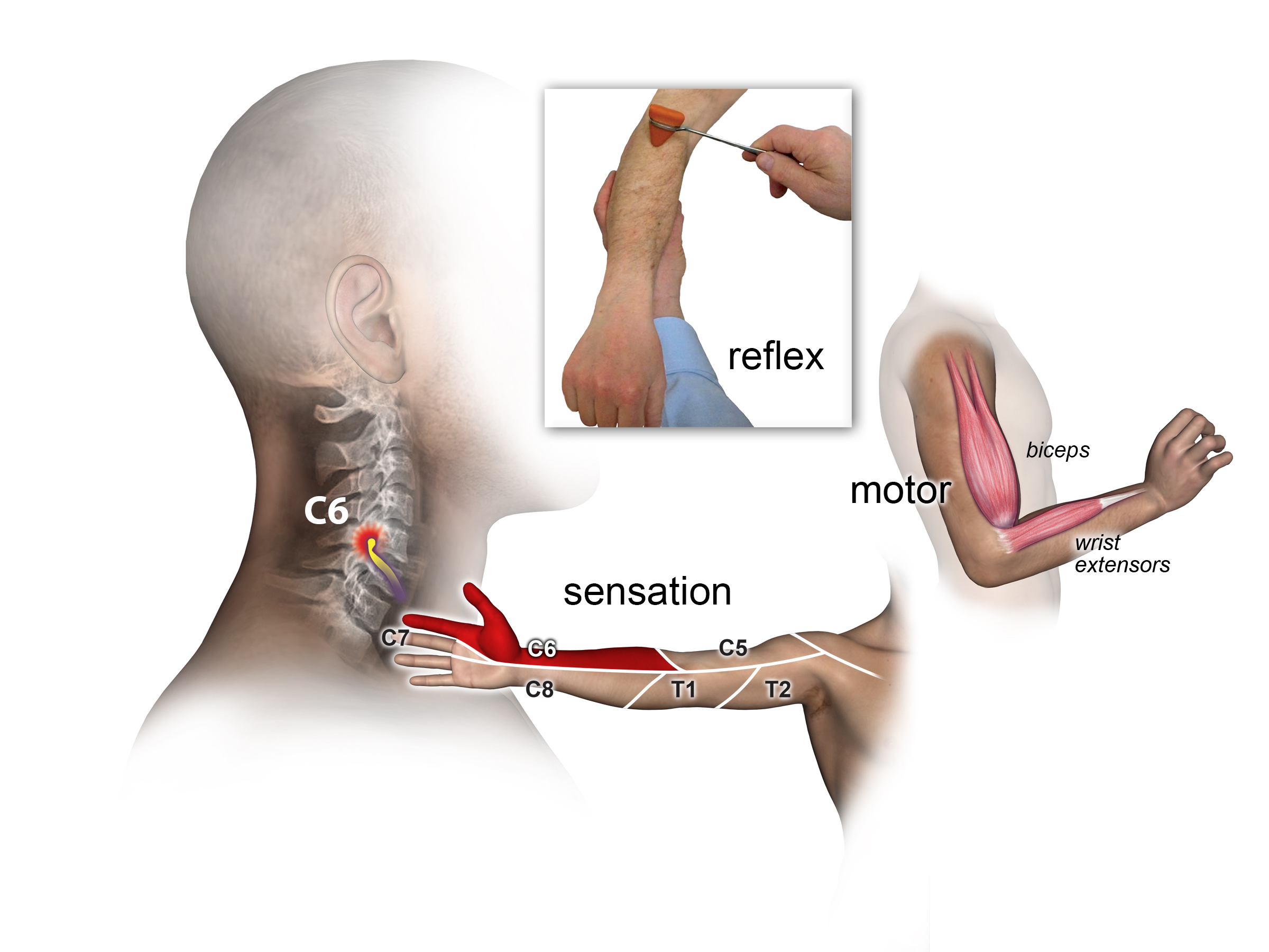 Motor, sensory and extensor reflex exam for C6 Root