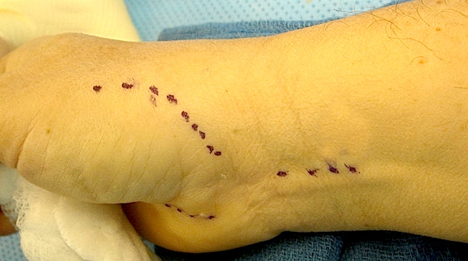 CMC OA Fascial Arthroplasty Incisions (Hover over right edge to see more images)