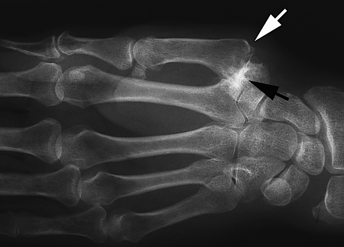  Another thumb CMC (Basal Joint) OA Stage II narrow with debris and osteophytes less than 2 mm; minimal joint narrowing with only a few small erosions only; joint subluxed about one third of joint width