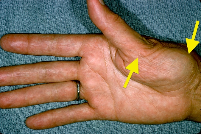 Thumb CMC (Basal Joint) OA with CMC Subluxation and MP Hypertension