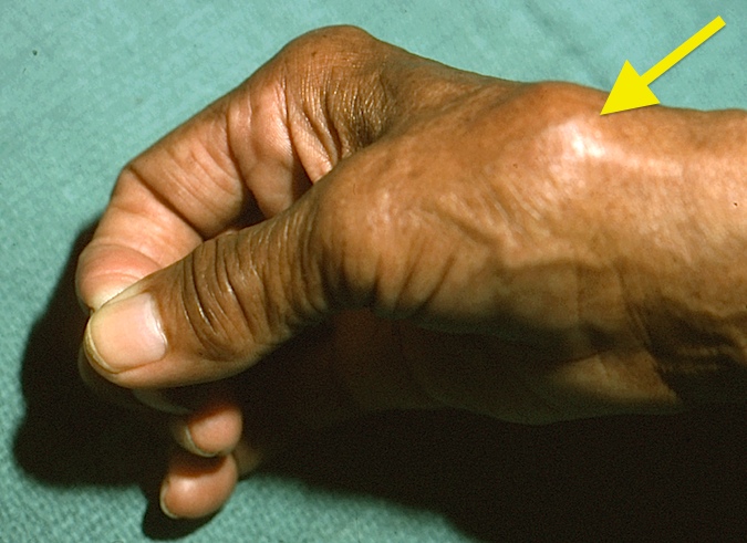 Thumb CMC (Basal Joint) OA with CMC Subluxation (Hover over right edge to see more images)