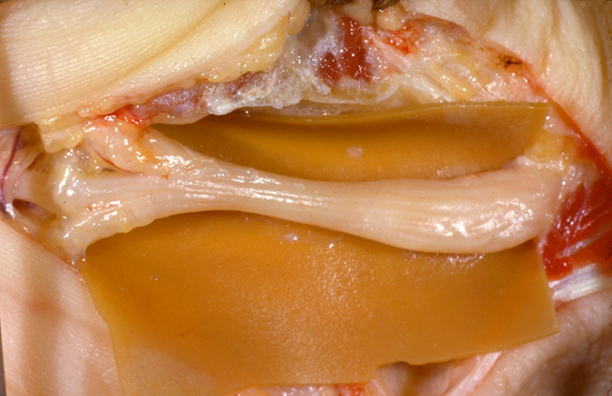 Compressed median nerve with pseudoneuroma proximally (right) and median nerve branches distally. (Hover over right edge to see more images)