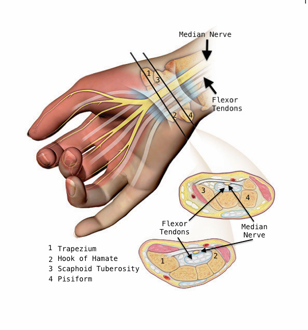 Carpal tunnel anatomy:   Carpal bones form the dorsal roof and the sides of the tunnel while the transverse palmar ligament forms the tunnel floor volarly. The tunnel contains nine flexor tendons and the median nerve.