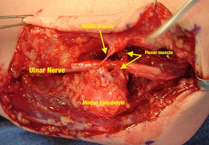 Cubital Tunnel Syndrome - Intramuscular Transposition