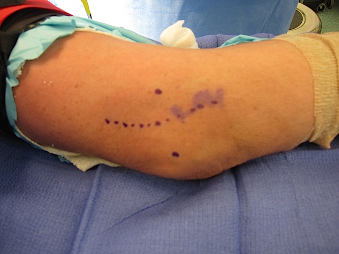 Carposcope Ulnar Neurolysis Incision (Hover over right edge to see more images)