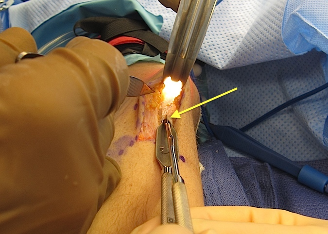 Carposcope Ulnar Neurolysis- Guide separating fascia from underlying ulnar nerve while forked knife(arrow) begins to cut fascia