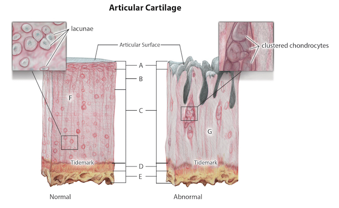 Normal and abnormal cartilage histology;A = Superficial zone; B = Transitional zone; C = Radial zone; D = Calcified zone; E = Cancellous bone; F = Cartilage matrix; G = Necrotic tissue with clustered chondrocytes