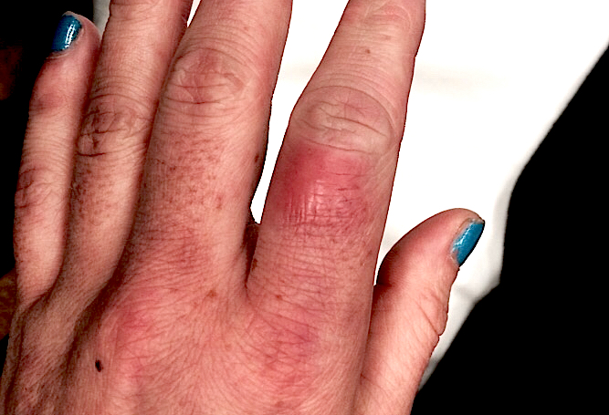 Cellulitis Left Index Finger  (Hover over right edge to see more images)