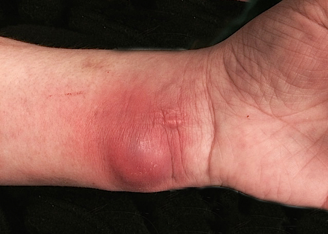 Cellulitis Left Volar Wrist with abcess