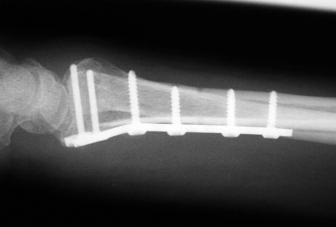 Internal fixed distal radius fracture lateral view