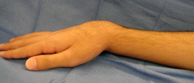 Silver Fork Deformity Secondary to Distal radius Fracture (Hover over right edge to see more images)