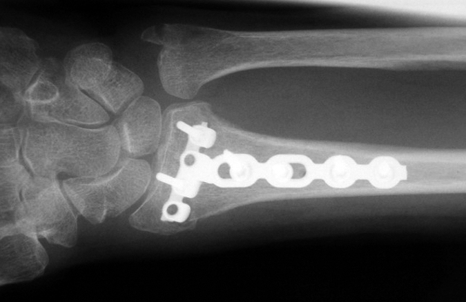 Internal fixed distal radius fracture AP view