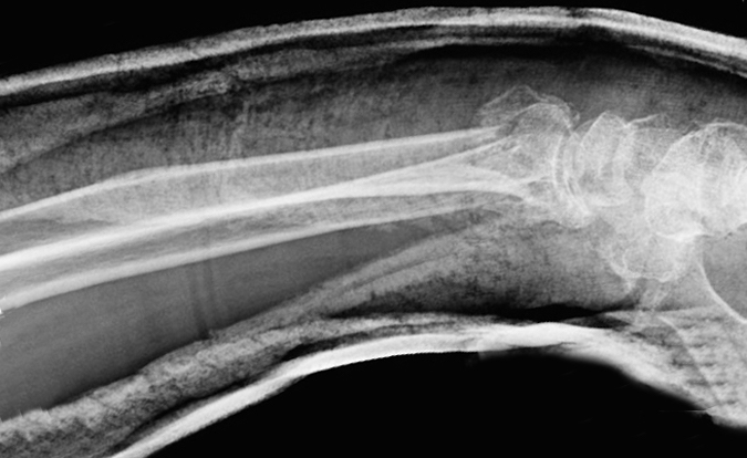 Lateral X-ray of a distal radius fracture in a short arm cast. Alignment acceptable