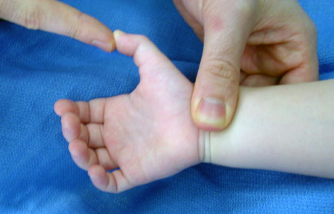 Pediatric Trigger Thumb (Formerly Congenital Trigger Thumb)