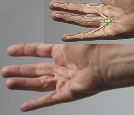 Central cord and two natatory cords combining to form a "crow's foot" cord and contact the MP joints of three adjacent fingers. Targets for collgenase in green.