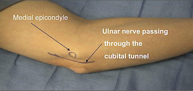 Cubital Tunnel Syndrome landmarks