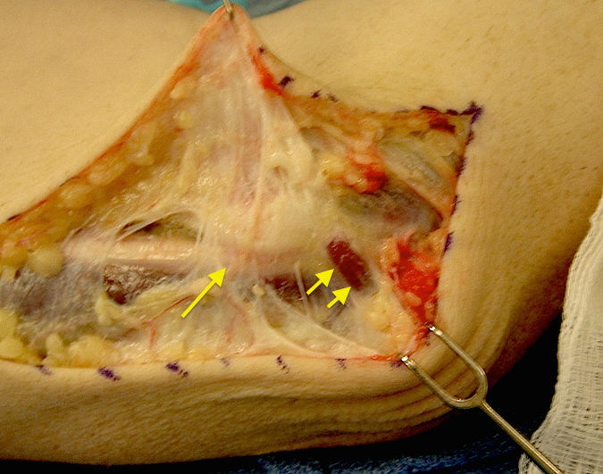 Cubital Tunnel-single arrow Osborne's ligament & double arrow ancoeus epitrochlearis muscle (Hover over right edge to see more images)