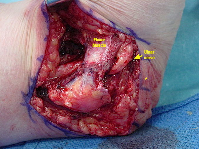 Cubital Tunnel Syndrome - Submuscular Transposition (Hover over right edge to see more images)