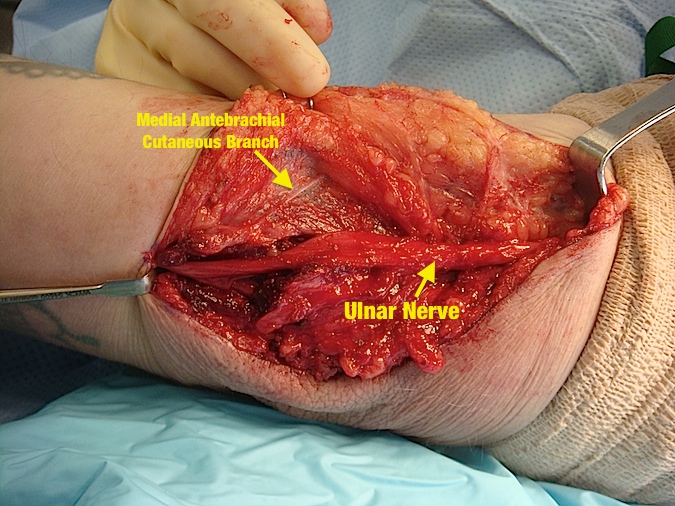 Cubital Tunnel Syndrome - subcutaneous transposition of the ulnar nerve (Hover over right edge to see more images)