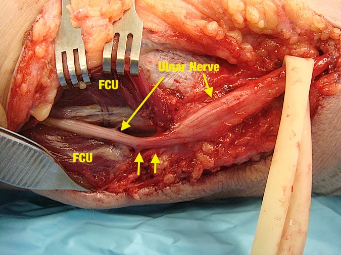 Cubital Tunnel Syndrome: Double arrow was the point of constriction caused by Osborne's ligament and proximal FCU sheath. Proximal swelling consistent with "Pseudoneuroma" of ulnar nerve entrapment.