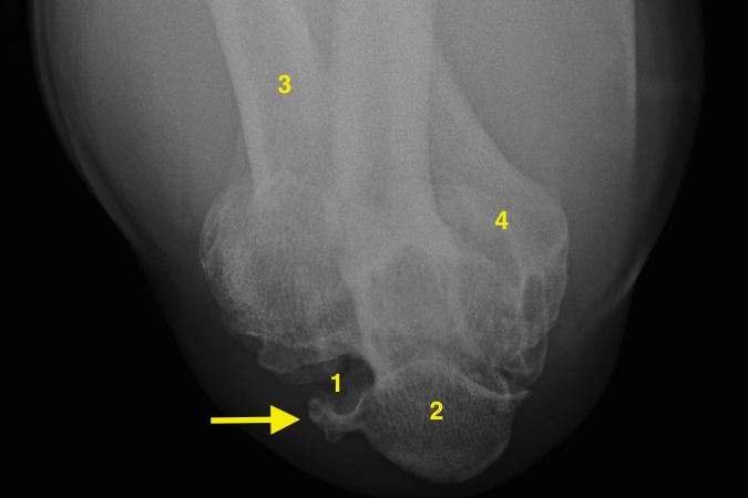 Cubital Tunnel view with arthritis.1.Cubital tunnel (Olecranon Grove); 2.Olecranon; 3.Proximal Radius; 4.Distal Humerus    Arrow - osteophyte compressing ulnar nerve.