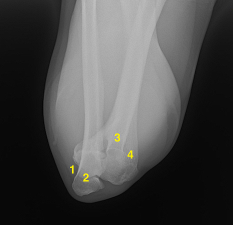 Cubital Tunnel view with no arthritis. 1.Cubital tunnel (Olecranon Grove); 2.Olecranon; 3.Proximal Radius; 4.Distal Humerus