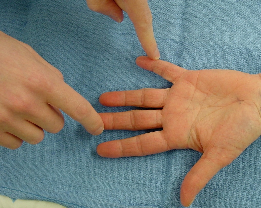 Testing median nerve sensation in long finger and comparing it to ulnar sensation in the little finger.