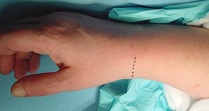 Transverse incision in Langer's lines just distal to the tip of the radial styloid (Hover over right edge to see more images)