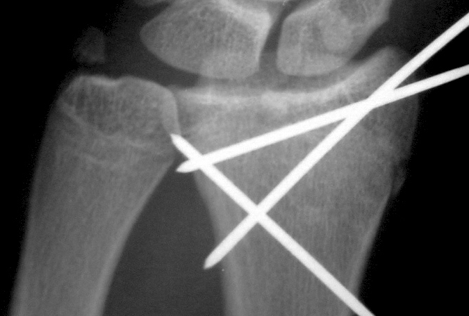 Intra-articular displaced distal radius fracture reduced and secured with pins and external fixation