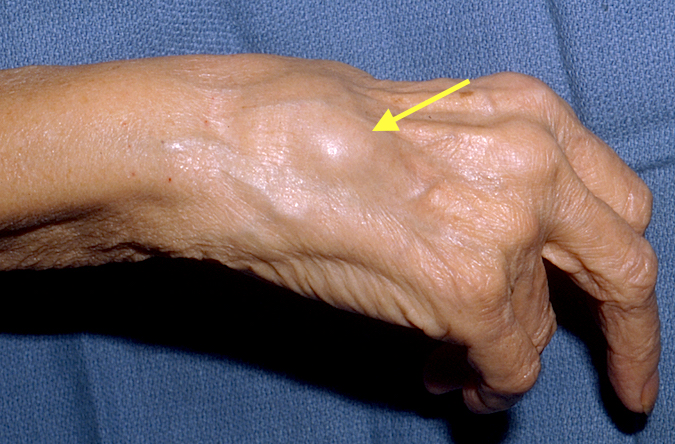 Dorsal Tenosynovitis at Arrow Right Wrist (Hover over right edge to see more images)